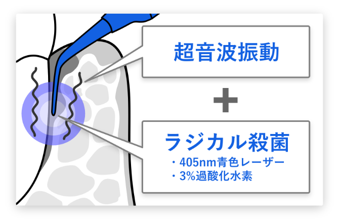 深部まで届くレーザー照射